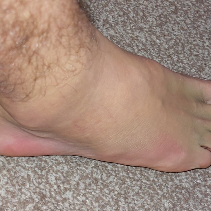 Injured foot 2