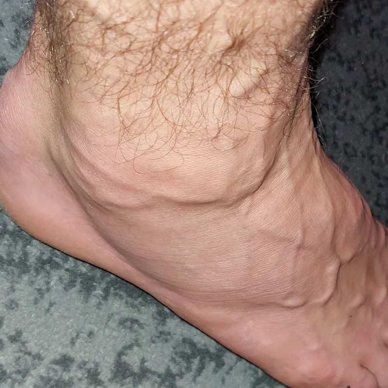 Injured foot