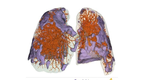 Qureight lung image