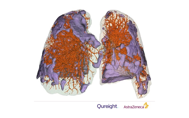 Qureight lung image
