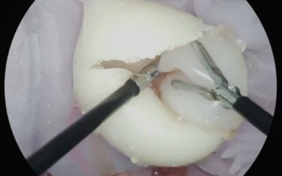 Cyst