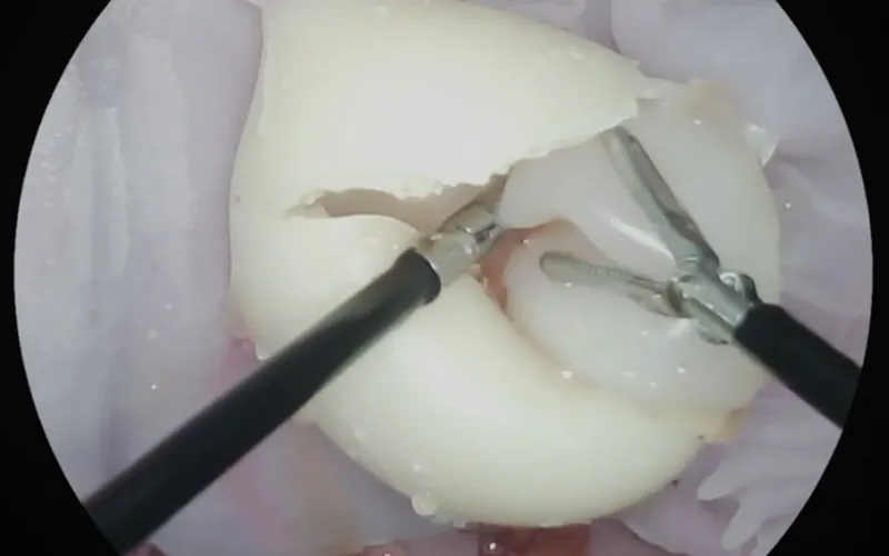 Cyst